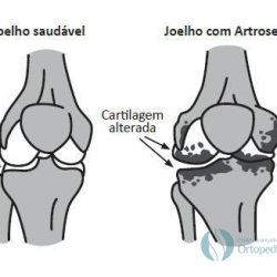 Diferenças entre um joelho saudável e um joelho com artrose